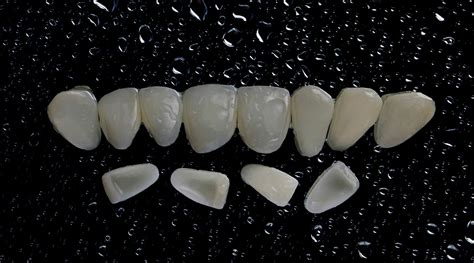 Composite Veneers In Turkey Findglob