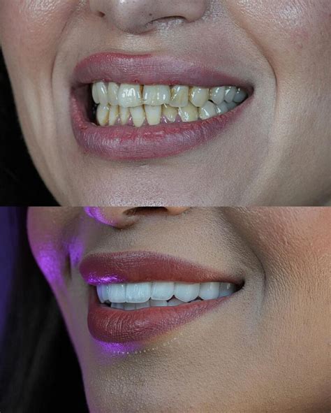 Dental Veneers In Turkey Cost Of Dental Veneers In Turkey