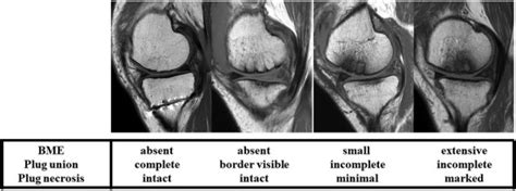 Mosaicplasty With High Tibial Osteotomy For Knee Subchondral Insufficiency Fracture Had Better