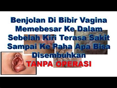 BENJOLAN DI BIBIR VAGINA MEMBESAR KE DALAM SEBELAH KIRI TERASA SAKIT