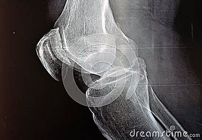 Plain X Ray Of The Right Knee Shows Apparent Joint Osteoarthritis According To Kellgren And ...