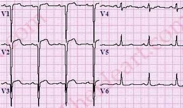 Left Ventricular (LV) Aneurysm ECG Review | Learn the Heart