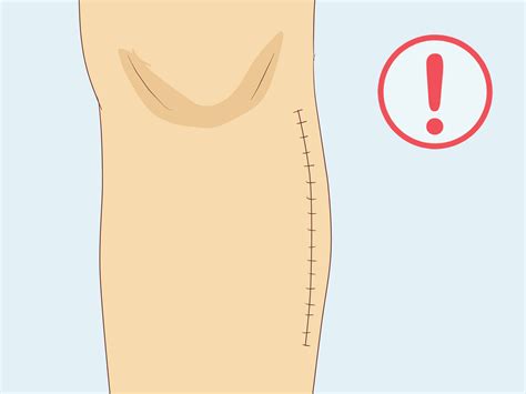 Gout: How to Recognize the Symptoms and Risk Factors