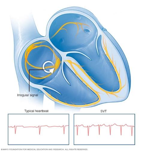 Supraventricular Tachycardia Symptoms And Causes Artofit