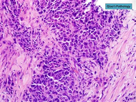 Qiaos Pathology Squamous Cell Carcinoma With Neuroendocrine