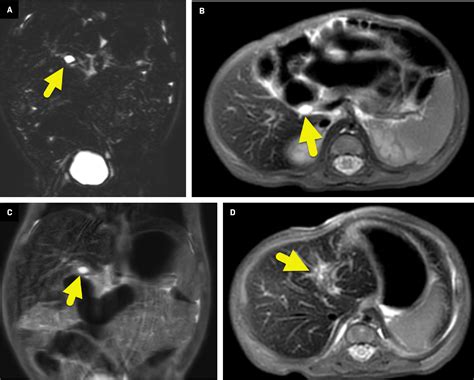 Cystic Biliary Atresia Applied Radiology