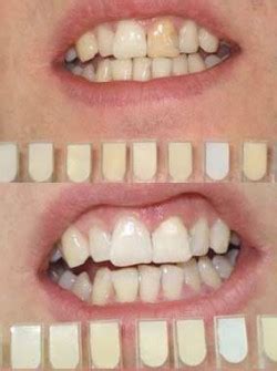 Internal Tooth Whitening - Ferry Dental Centre - Dentist Southampton ...