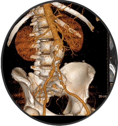 CT Angiography Before Implantation In Volume Rendering VRT