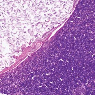 Photomicrograph Of The Patients Right Axillary Sentinel Lymph Node