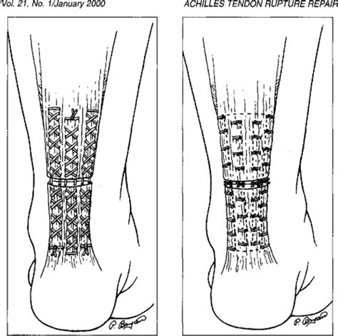 Figure From Achilles Tendon Rupture Repair Biomechanical Comparison