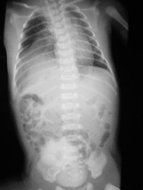 Diaphragmatic Hernia X Ray