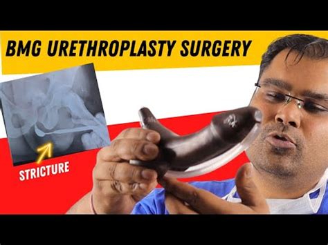 Urine Pipe Ki Surgery BMG Urethroplasty Live YouTube