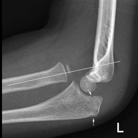 Upper Limb Radiology Flashcards Quizlet