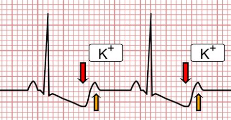 Hyper Vs Hypokalemia Ecg - Ghana tips