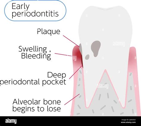 Illustration By Stage Of Periodontal Disease Early Periodontitis Stock