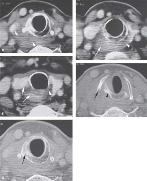 Hypopharynx Malignant Tumors Radiology Key