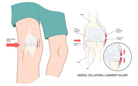 Medial Collateral Ligament (MCL) Injury