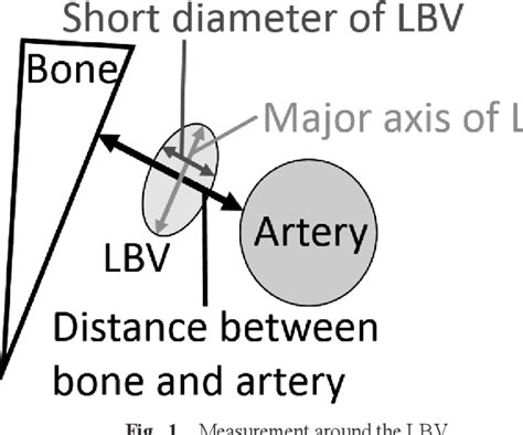 Figure 1 from Anatomical Study on the Left Brachiocephalic Vein Compression by Using CT Image ...