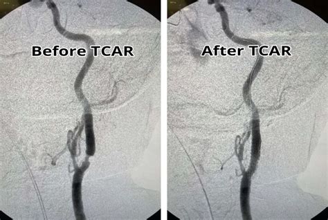 Transcarotid Artery Revascularization TCAR Southern California