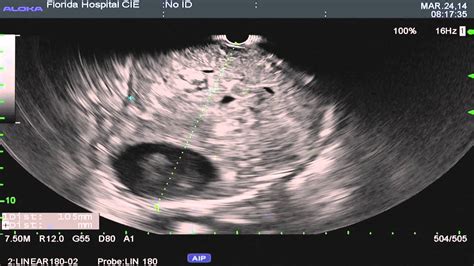 Diagnosis Of Gist By Eus Fna Bronte Holt Youtube