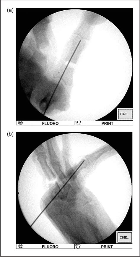 Figure From Percutaneous Fixation Of Unstable Proximal Phalanx