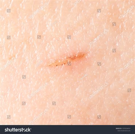 Wound On Human Skin Background Stock Photo Shutterstock