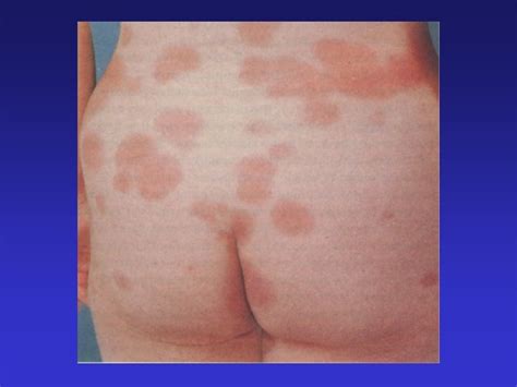 Cutaneous Symptoms And Signs Cutaneous Symptomssubjective Symptoms