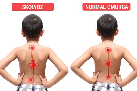 Skolyoz Nedir Tedavisi ve Ameliyatı Nasıldır Turan Turan