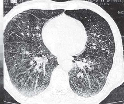 Ct Thorax Lung Window Showing Diffuse Intra Alveolar Opacities Of