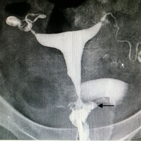 Hysterosalpingogram Showing A Normal Uterine Cavity With Contrast