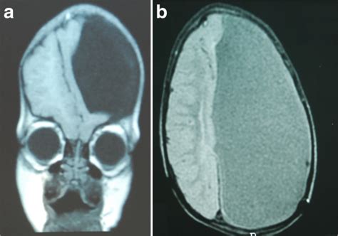 Hydranencephaly Mri