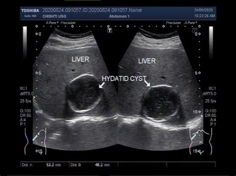 Ultrasound Video Showing Hepatic Hydatid Cyst And Uterine Hemangioma