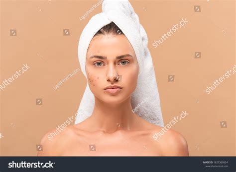 Nude Girl Towel Acne On Face Stock Photo Shutterstock