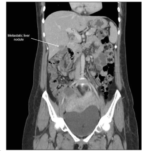 Liver Segments CT Scan Images, Photos | Mungfali