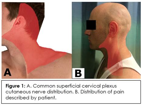 A Case of Successful Treatment of Iatrogenic Superficial Cervical ...