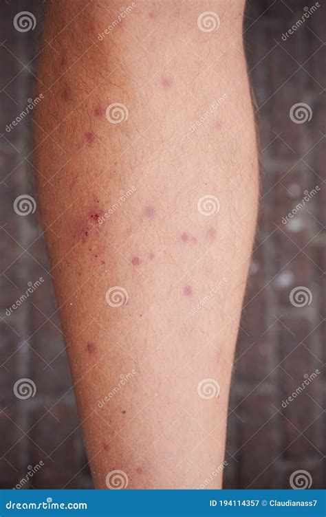 Multiple Bites Of Grass Mites On A Male Leg Stock Image Image Of Skin