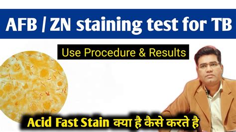 What Is Afb Zn Stain Test For Tb Full Form Use And Procedure Of