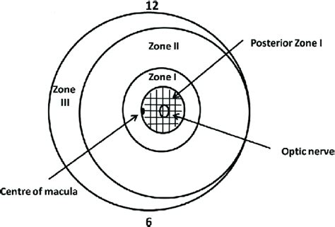 Diagram Showing The Zones Of Retinopathy Of Prematurity Rop And Area