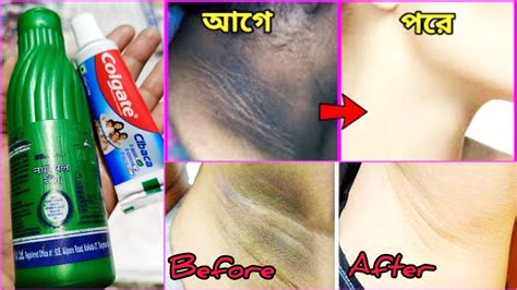 Whiten Dark UNDERARMS instantly permanently ঘড ও হতর কল দগ দর