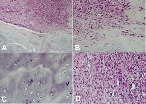 Histopathology Of Dedifferentiated Chondrosarcoma A B The Tumor Was