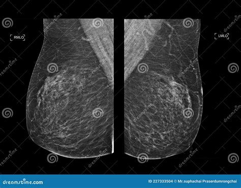 Breast Cancer Digital Mammogram