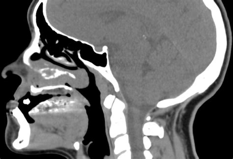 Radiology Of Cleft Lip And Palate Imaging For The Prenatal Period And