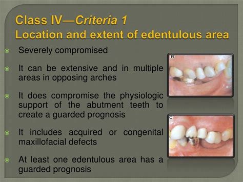 Classification Of Rpd