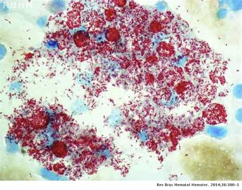 Mycobacterium Leprae Acid Fast