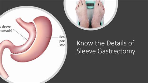 Know The Details Of Sleeve Gastrectomy Sleeve Gastrectomy Gastric