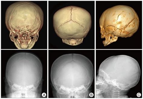 Linear skull fracture in the simple X-ray and 3 dimensional computed ...