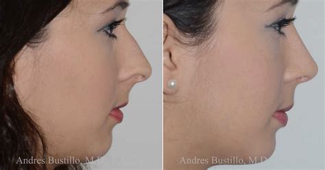 Rinoplastia Miami Fl Cirugía De Nariz Andres Bustillo Md Facs