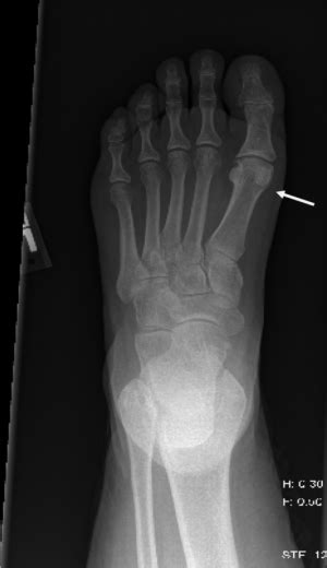 Non-fifth metatarsal fracture - WikEM