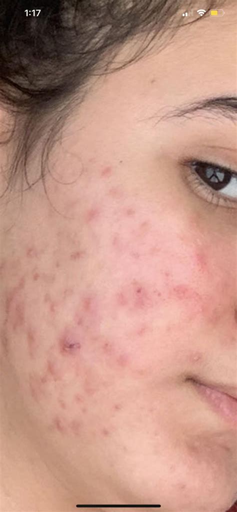 One year after finishing my 6 month treatment and my skin still doing