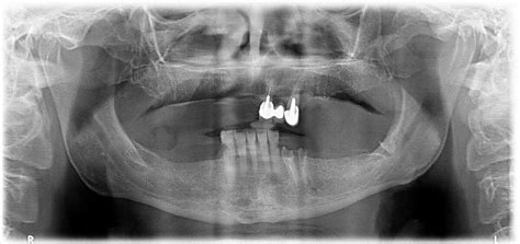 Bar-retained implant overdenture for treating edentulous maxilla | TRATE